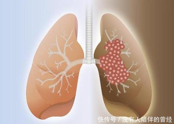 做饭|45岁大妈确诊肺癌,从不碰烟,医生痛斥不是只有吸烟才伤肺