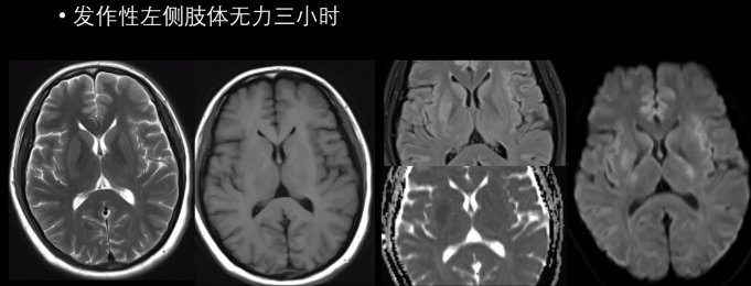 大脑血管疾病|5大脑血管疾病的MRI表现，一文总结