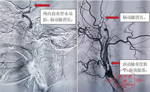 动脉|早起时突发脑梗险致命，哈医大四院多学科联动为患者脑动脉闭塞取栓治