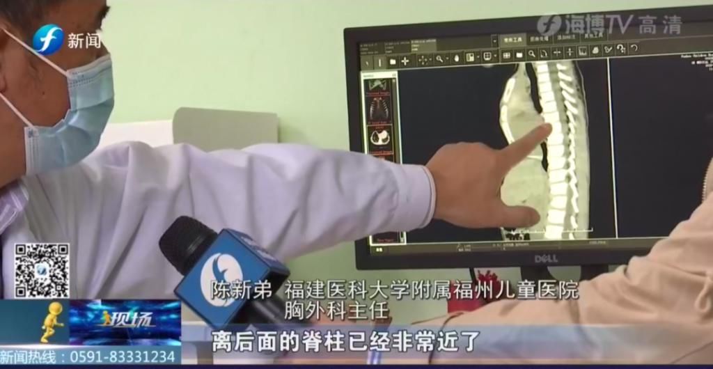  女童|5岁女童＂漏斗胸＂凹陷紧邻心脏，离脊椎不足5厘米！
