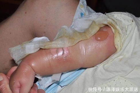 伤情|孩子被烫伤后该先冲水还是先脱衣服这一步错了,可能伤情会更重