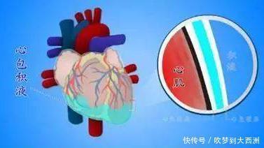积液|一场流感可能引起心包积液，心包积液怎么治疗心包积液怎么护理
