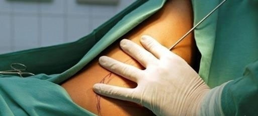 小冉 “裹小脚”式审美!33岁网红“手术抽脂”身亡:ICU内熬了2个月!