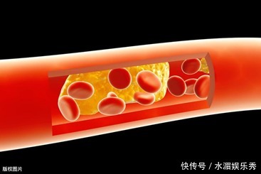 日本研究发现：“血管变硬”竟和一顿饭有关，看看你吃没吃