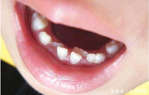 每个孩子|6岁孩子长出双排牙,赶紧带去医院检查,得知原因宝妈后悔不已