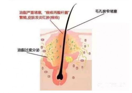 痤疮|拒绝做“痘女郎”，这些年你的祛痘方式对了吗？