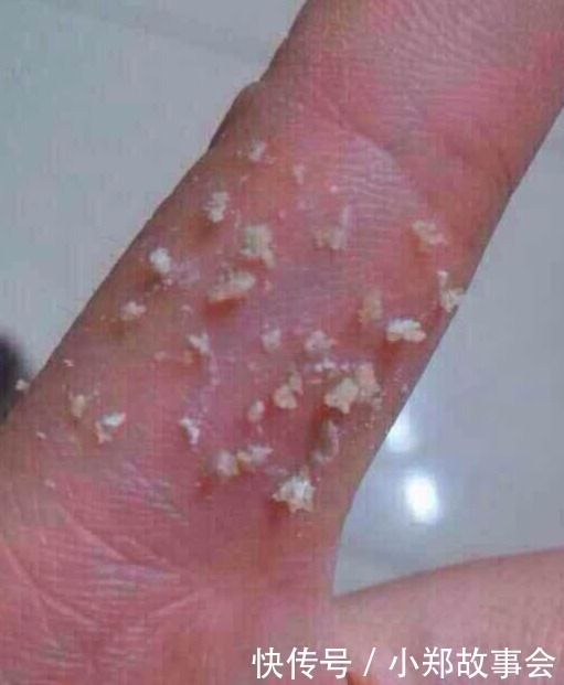 黑头|先别慌着挤黑头,这3种原因你知道了再挤也不迟