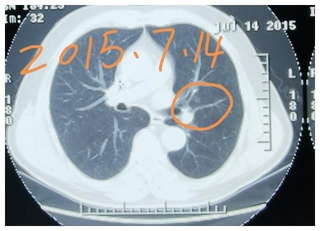 肺磨|刘懿博士说肺癌(三〇一五)6年长3mm,肺磨玻璃结节长得快还