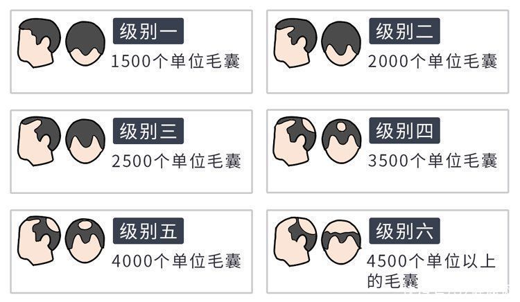 移植|揭秘植发全过程:一次植发能维持多久?哪些人不适合做?有多贵?