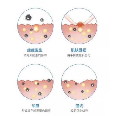 痘印|“零差评”的5款网红护肤品,控油祛痘超级好用,回购率超级高