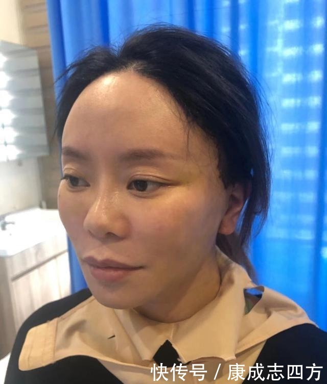 求美者|小拉皮术后1个月,总结几点我的体验感受