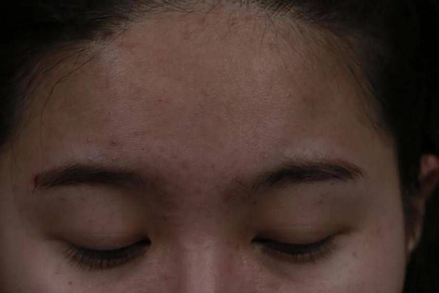 褪黑 祛斑失败后的怎么治疗