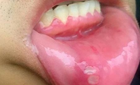 饮食|出现口腔溃疡,饮食谨记“3吃、2不吃”,轻松帮你赶走“溃疡”