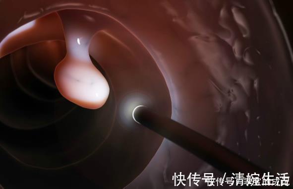 腺瘤性息肉|四部分的息肉,最好及时切除,癌症可能会出现很长一段时间!