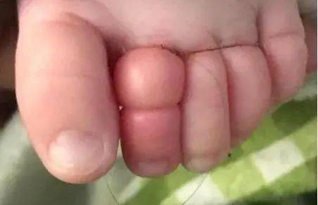 线头|2个月宝宝险被截肢,每小时放一次血!凶手竟是妈妈一根头发