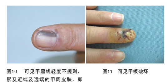 癌症|指甲上有黑线,可能是最恶的癌症,医生教你怎么办