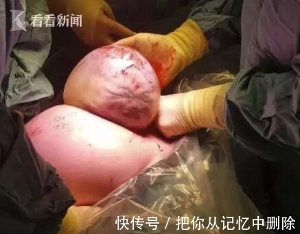 未婚夫|医生从妈妈肚子里取出一个肉球!网友:这是哪吒啊