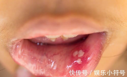 疾病|有2种病外号不死的癌症,医生:没有特效药,没办法根治