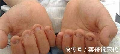 咬指甲|5岁女孩喜欢“咬指甲”,宝妈无奈求医,医生太晚了,拔了吧