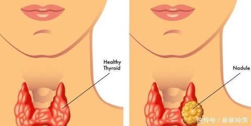 银杏|甲状腺有结节的人,常吃三物,帮你活血散结,结节可能会悄悄好转