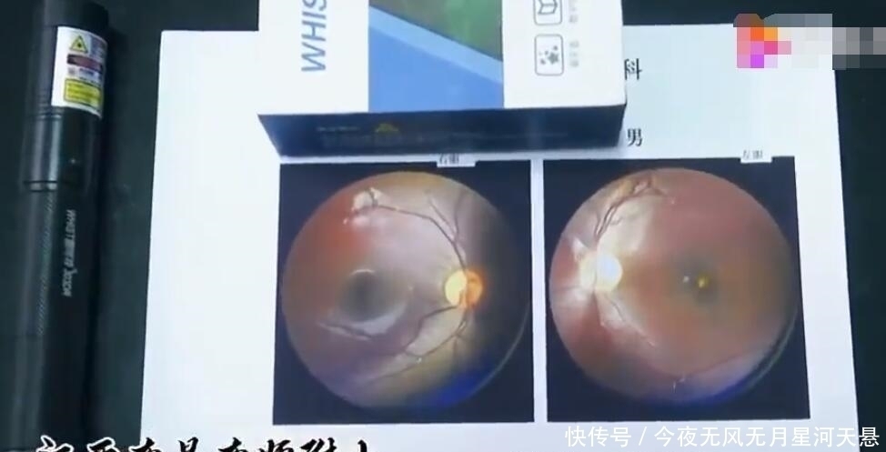 猪皮|小学生被激光笔照射六秒致左眼永久失明,孩子父亲:希望加大监管力度