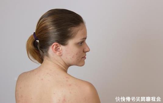 痘痘|后背痒抠下小颗粒，后背沦为螨虫“江山”，2洗1吃，螨虫将蹭蹭掉