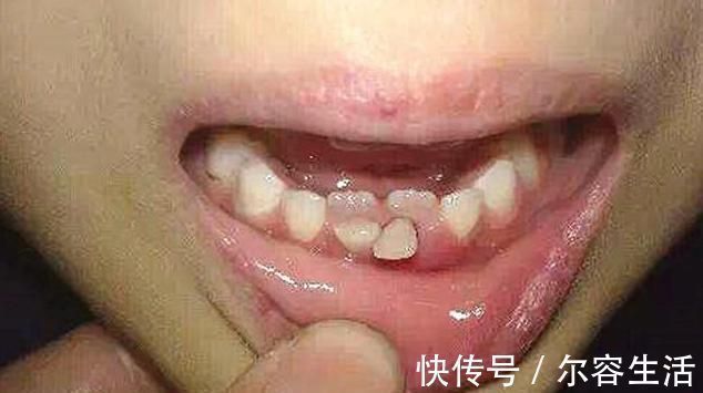 双排牙|越来越多孩子长“双排牙”,与糖果无关,是父母喂养有误区