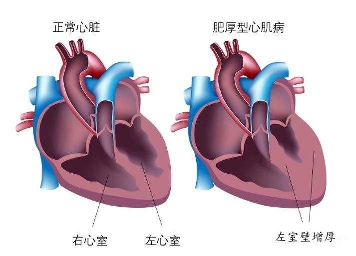 心血管内科|自贡一医院采用微创消融术成功为心脏“瘦身”