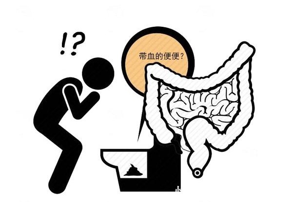 粪便|大便“先硬后软”是大肠癌征兆?医生忠告,4种异常便别掉以轻心