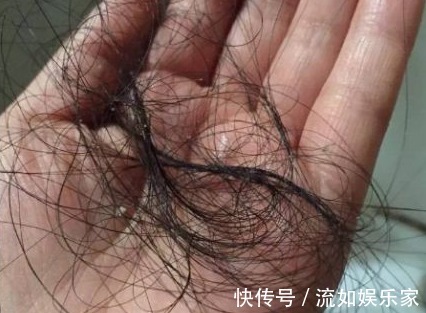 辛辣刺激|医生提醒 脱发是你亲手喂出来的,4种食物不忌嘴,迟早成地中海