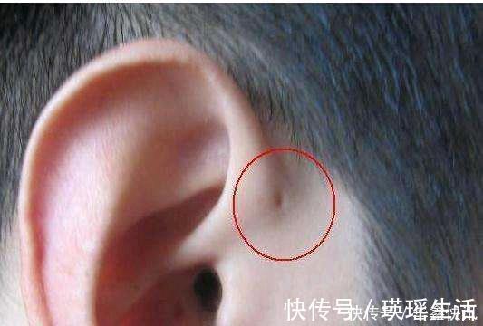 宝妈|儿子的耳朵上有个小洞宝妈试图挤压,导致孩子昏迷,被送到医院