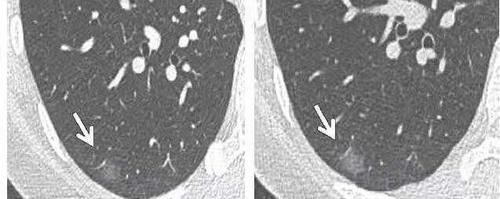肺部|肺部磨玻璃结节8mm怎么办?如何判断良恶性?医生教你一招