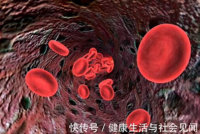 乏力|频繁头晕、乏力可能是贫血!谢别录:贫血有很多种,看你是哪一种