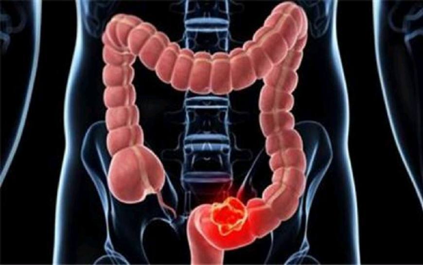 排便|为什么肠道“喜欢”长息肉可能和3个习惯有关,不妨多了解