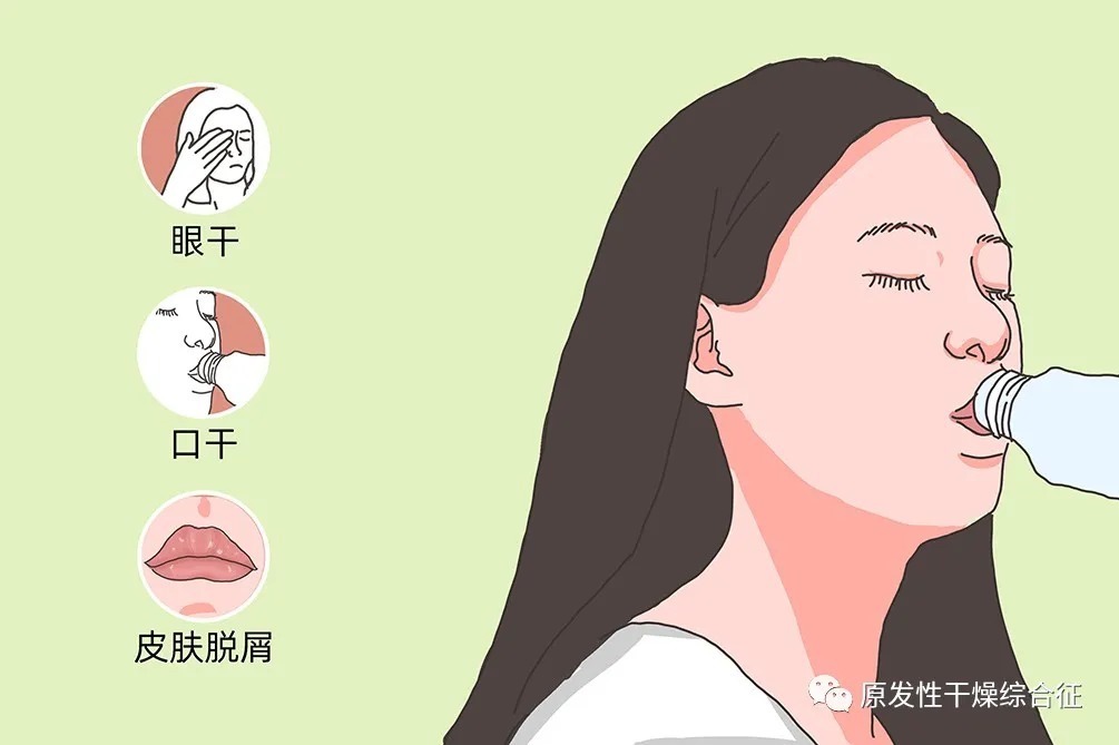 口干症|干燥综合征有哪些多样表现？