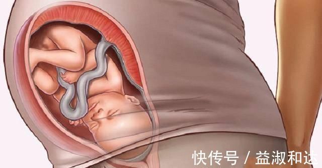 腹带|有一种孕肚,不仅入盆有点困难,孕晚期还需要托腹带,希望你没中