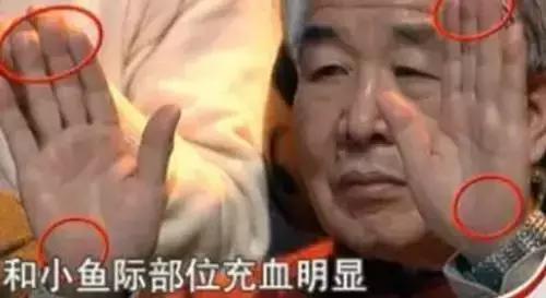 有没有|这条糖尿病线,你手上有没有如果看到它,请注意了