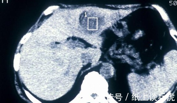 生存期|“不要抢救我”！65岁老人肝癌晚期拒绝手术化疗，带着尊严离去