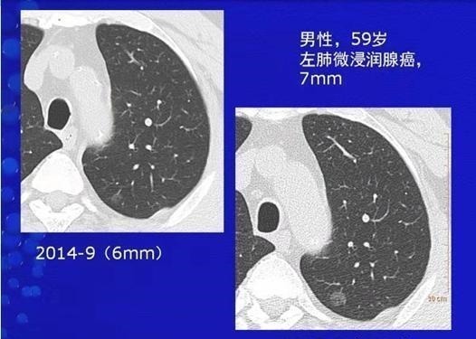 治疗|两个肺癌病人都拖了2年才治疗，一个治愈，一个扩散了