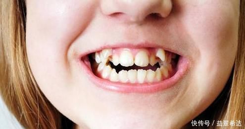 儿子因“口臭”被同学嫌弃，带孩子检查，取出来的颗粒果然很臭