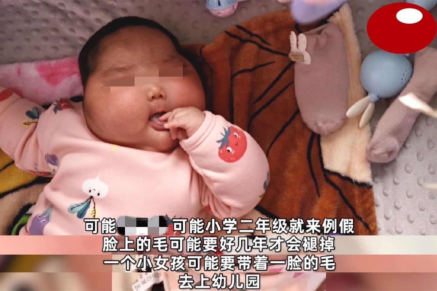 抑菌|“大头娃娃”再现,抑菌霜激素超标,致5个月女婴疯狂长胖长毛