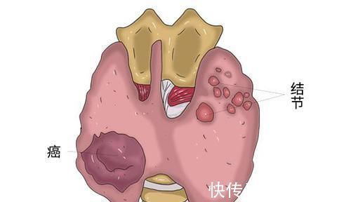 甲状腺囊肿|甲状腺囊性结节，会自愈吗？管住嘴，4种食物不去碰，或不是难事