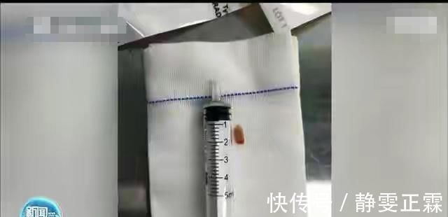 婴儿|粗心家长喂食八个月婴儿排骨,导致窒息婴儿命悬一线