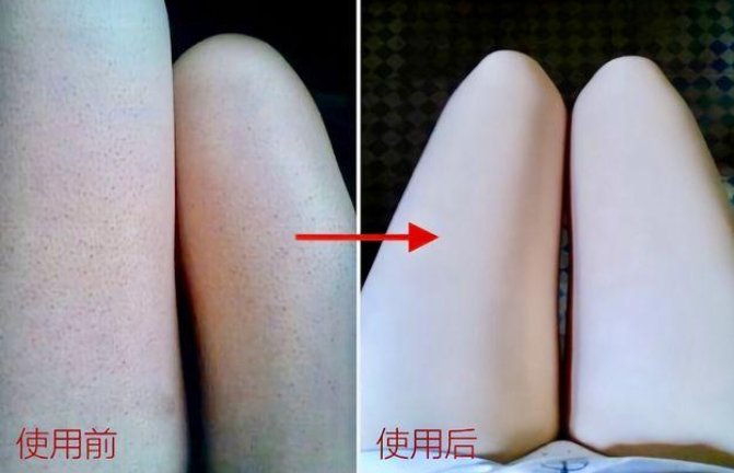 夏季穿衣不敢露肤？“鸡皮肤”女生做好这些事，轻松养成牛奶肌