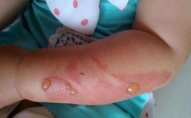 衣服|孩子被烫伤,应该先脱衣服还是先冲水?做错一步可能加重伤情