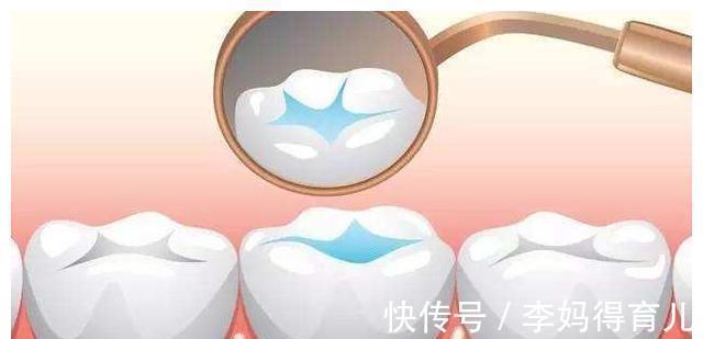 磨牙|窝沟封闭做一次可以保护一辈子?