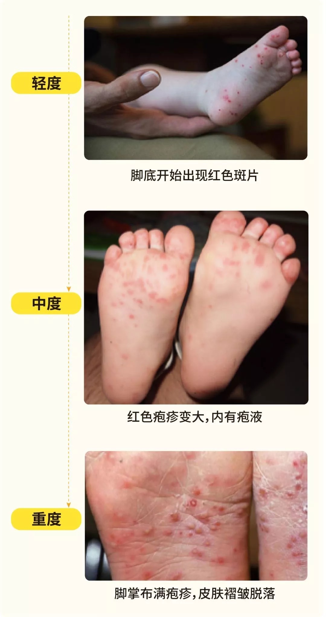 杨俊|柳州已有班级停课!这种传染病进入高发期,如何预防、护理看这→