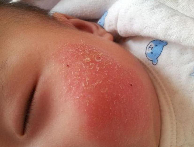 宝宝|宝宝患有特应性皮炎，家长日常如何防护？