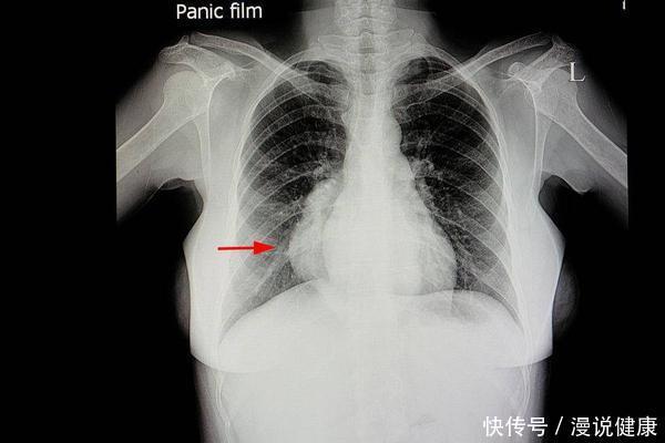 肺癌|肺癌是“气”出来的?医生坦言:你肺最受不了这4种“气”