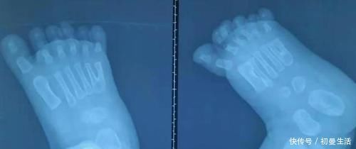 畸形|新生儿出生后有6个脚趾,医生在指尖“绣花”,网友:巧夺天工